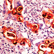     CA19-9 / CA19-9 / Sialyl Lewis^a^ (GI Tumor Marker) 