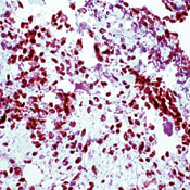        1 (WT1)  / Wilm’s Tumor Protein (WT1).